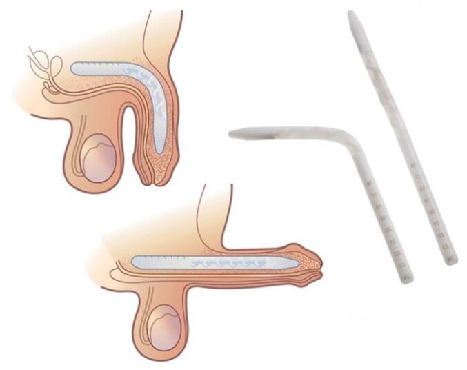 Falloplasty to increase the member