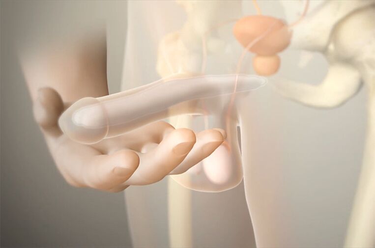 gel implants to increase the member