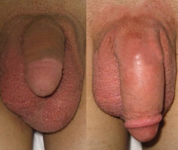 The result of the incorporation of a collagen matrix into the penis