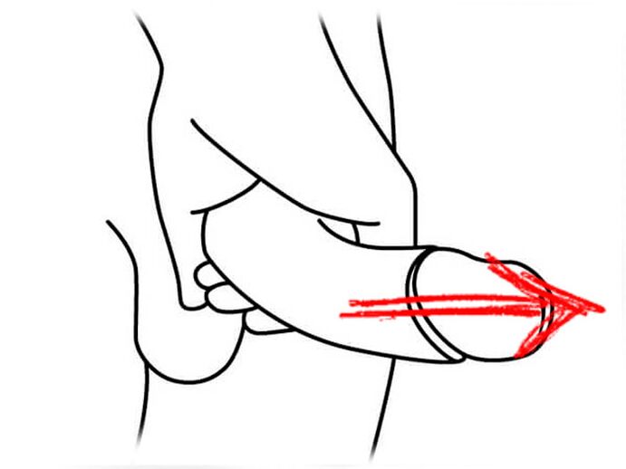 Extending the penis to increase